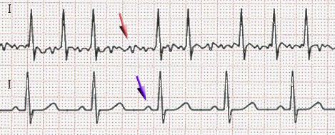 Atrial fibrillation